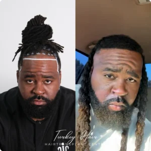 Before & After Hair Restoration Excellence You Can Trust