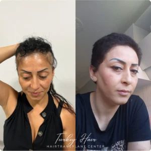 Before & After Hair Restoration Excellence You Can Trust