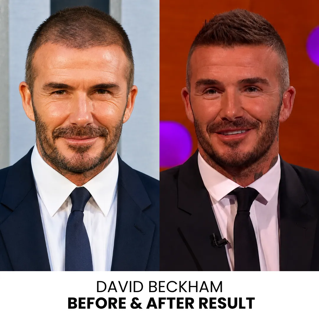 David Beckham Before and After Hair Transplant David Beckham before and after hair transplant hairline and density comparison
