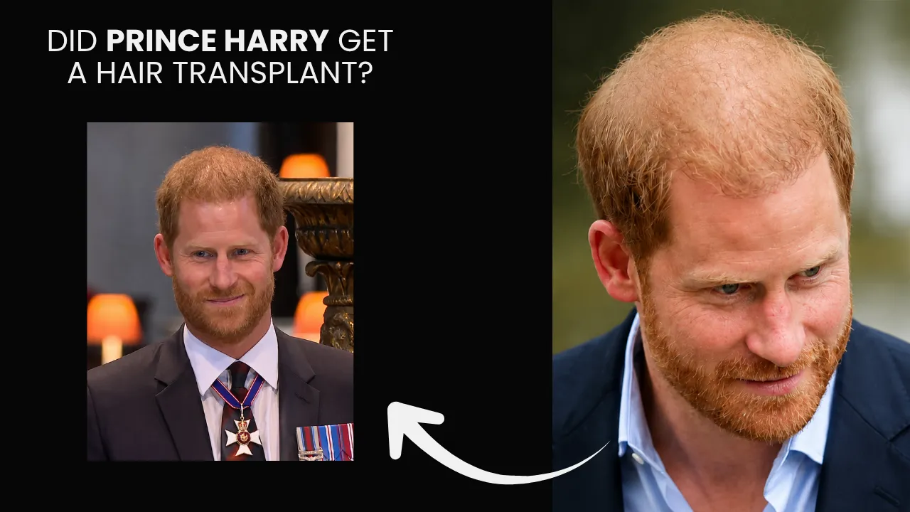 Prince Harry Hair Transplant: Before & After, Crown Density Analysis