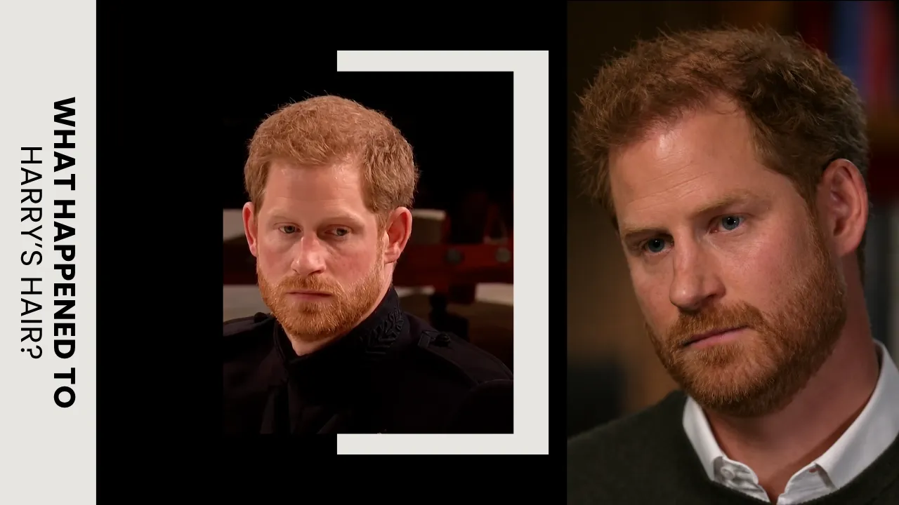 Prince Harry Hair Loss and Hair Transformation Analysis Prince Harry close-up portraits highlighting visible hair thinning and changes in hair density over time.