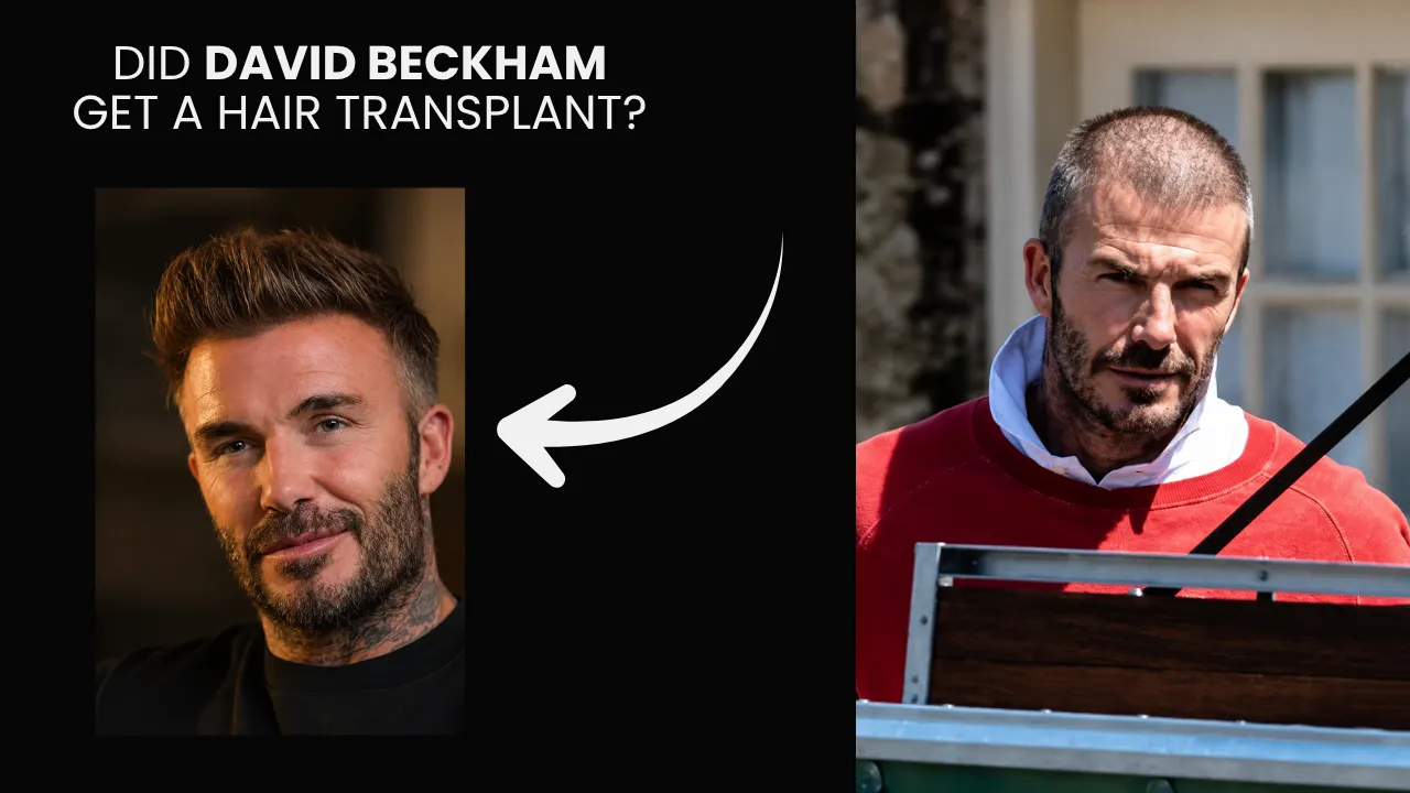 Did David Beckham Get a Hair Transplant Did David Beckham get a hair transplant before and after hairline comparison