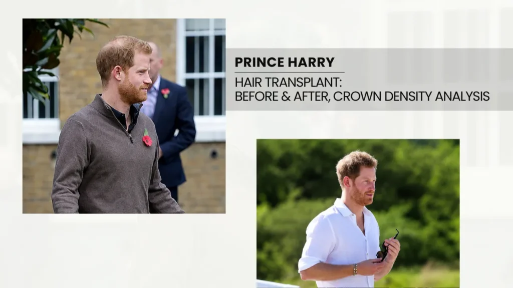 Prince Harry hair transplant before and after comparison focusing on crown density and visible hair thinning analysis.