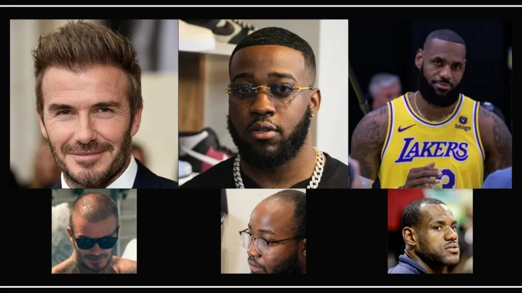 LeBron James vs Jidion vs David Beckham Hair Transplant Comparison LeBron James, Jidion ve David Beckham saç ekimi öncesi ve sonrası sonuçlarının karşılaştırılması