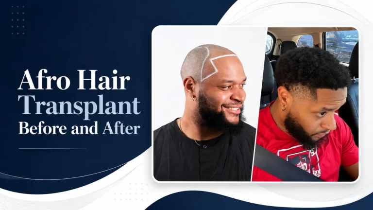 Afro Hair Transplant Before And After: 17 Real 12-Month Results & Expert Analysis 3 Afro Hair Transplant Before And After: 17 Real 12-Month Results & Expert Analysis