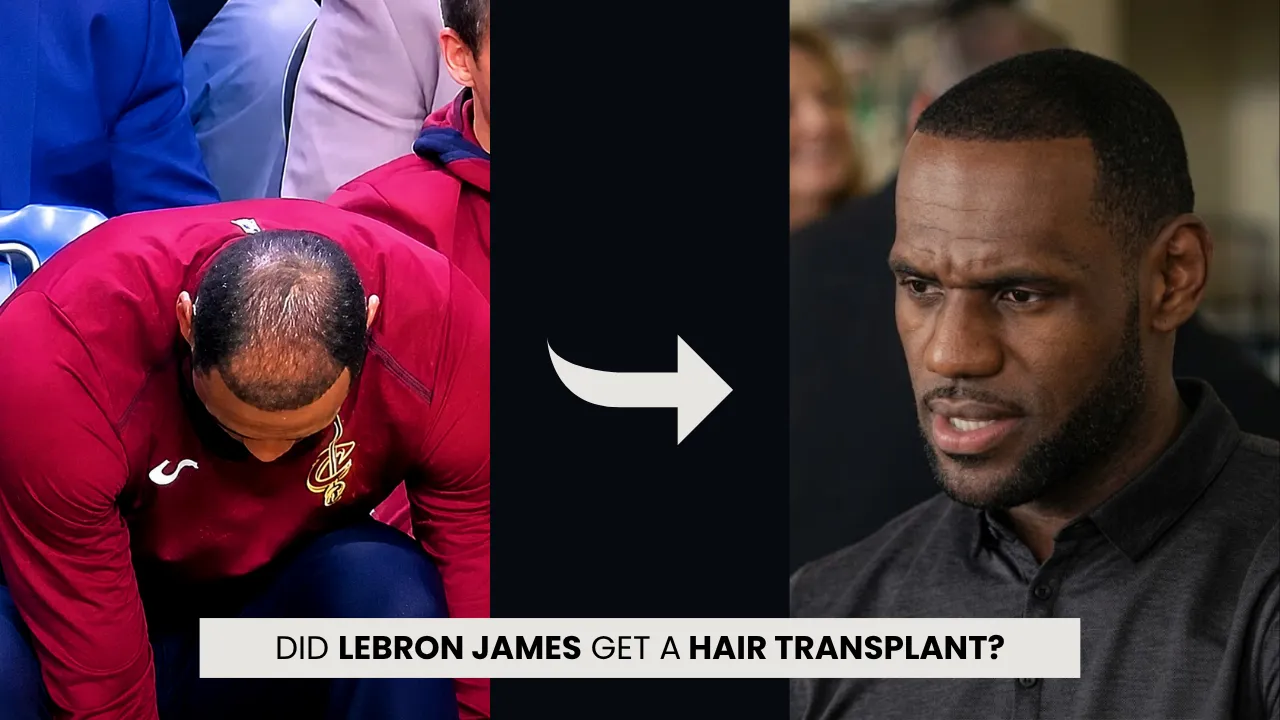 LeBron James Hair Transplant: Hairline Analysis
