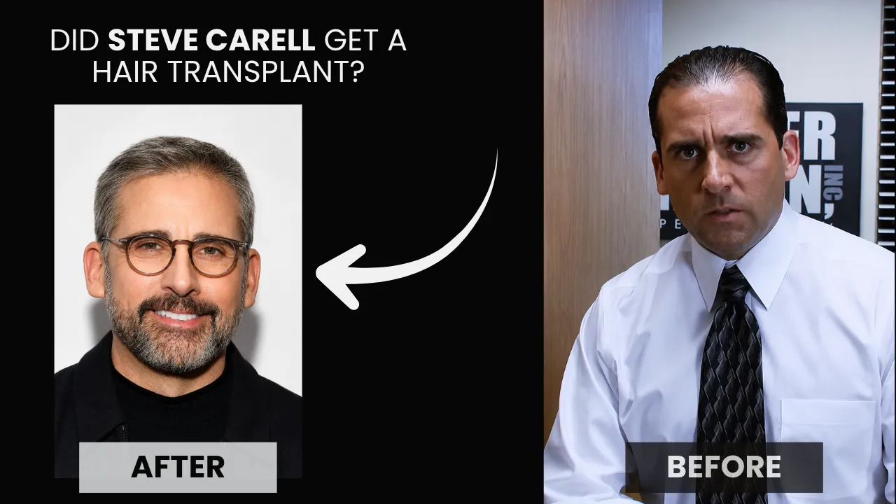 Did Steve Carell get a hair transplant before and after hairline comparison