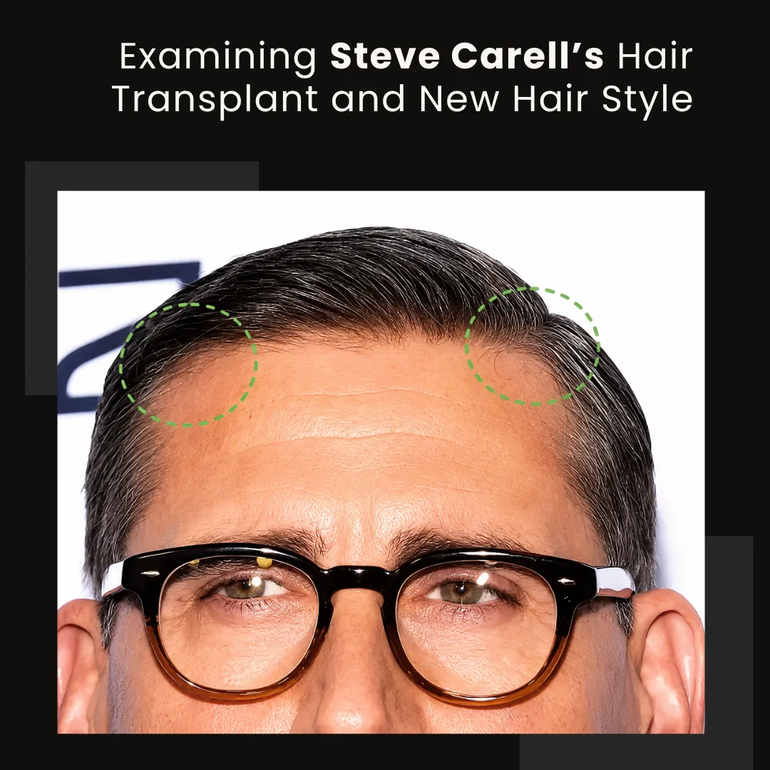 Steve Carell hairline analysis showing temple areas and possible hair restoration signs