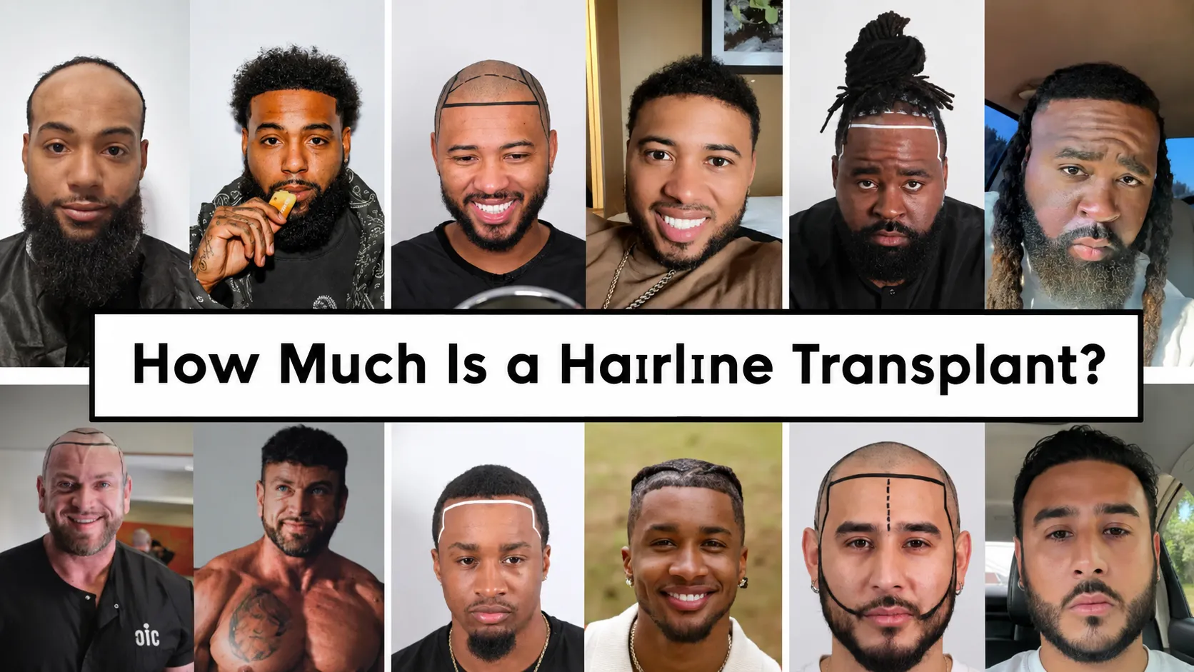 How Much Is a Hairline Transplant? Cost Guide