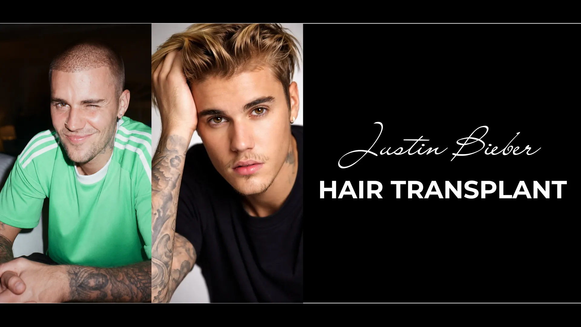 Justin Bieber Hair Transplant: Hairline Analysis, Before & After Photos, Rumors & Expert Opinion