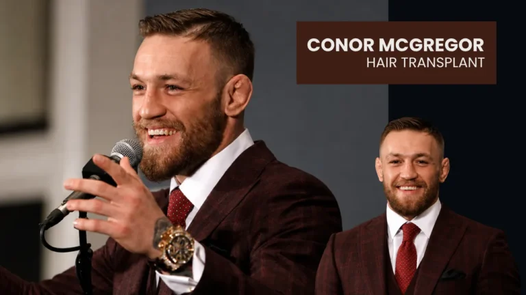 Conor Mcgregor Hair Transplant Before And After Hairline Restoration Analysis