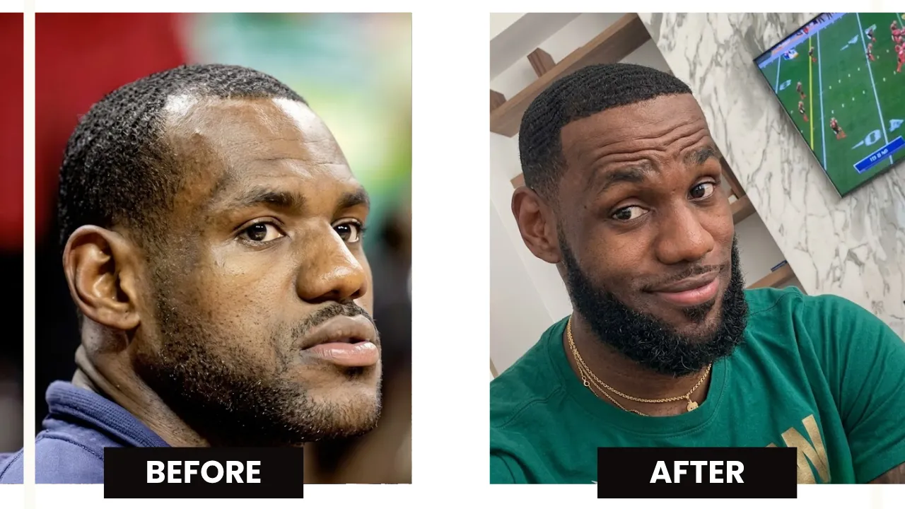 LeBron James before and after hairline comparison showing earlier thinning and fuller later hairline