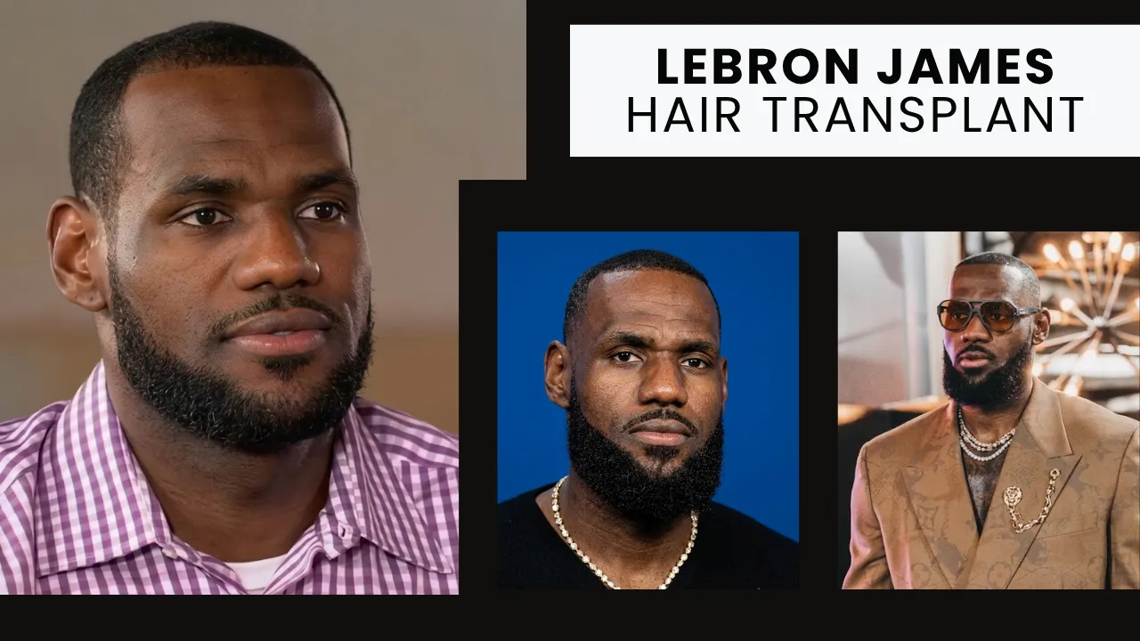 LeBron James Hair Transplant Hairline Analysis LeBron James hair transplant visual analysis showing hairline changes across different years