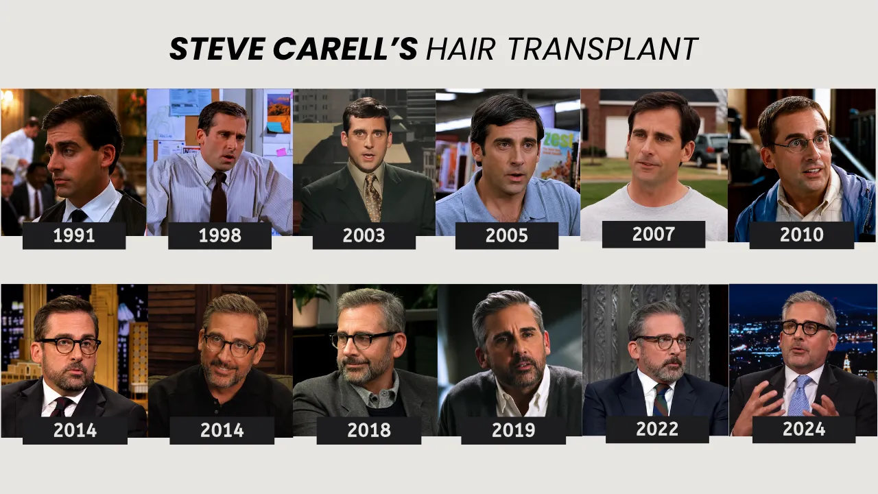Steve Carell hair transplant timeline from 1991 to 2024 showing hairline changes over time
