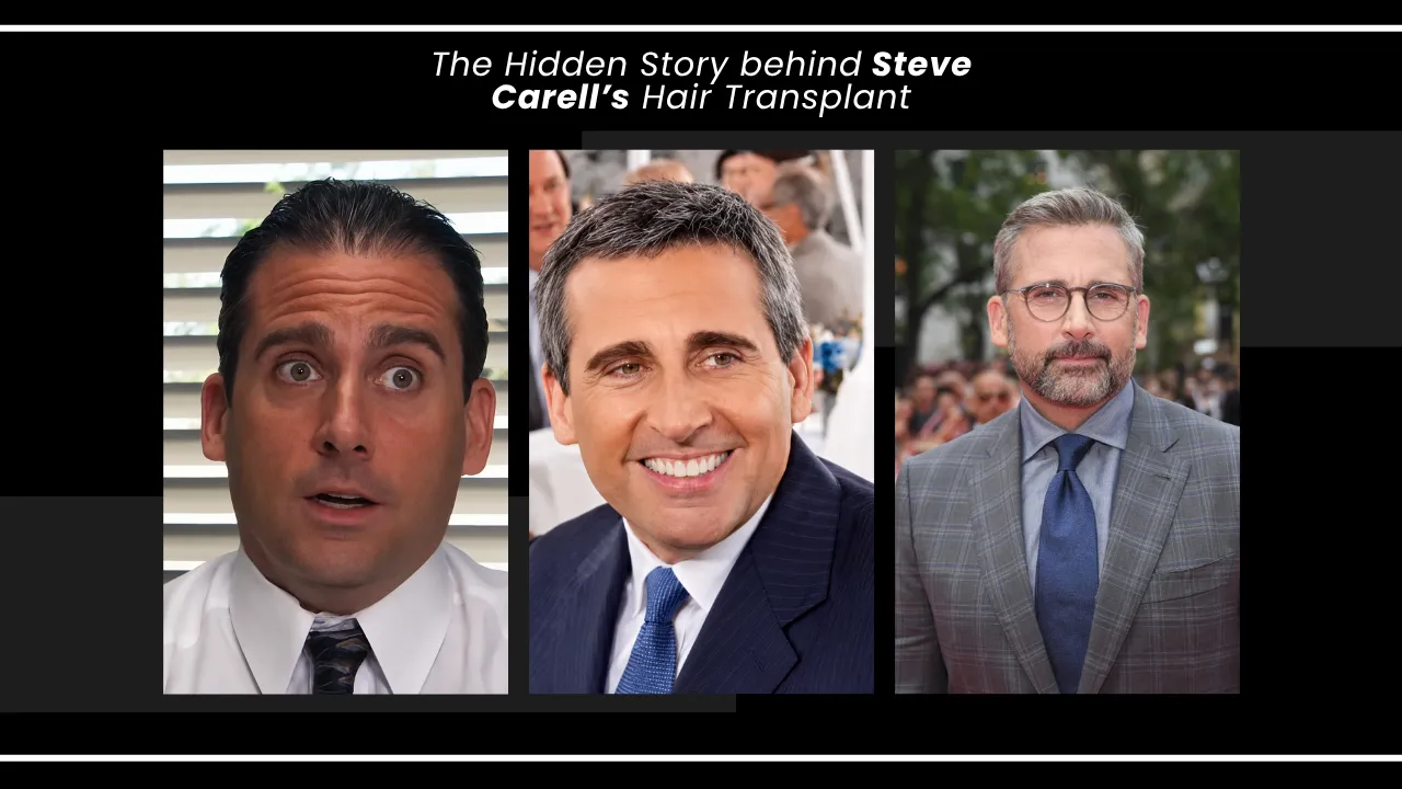 Steve Carell hair transplant before and after hairline comparison from The Office to recent years