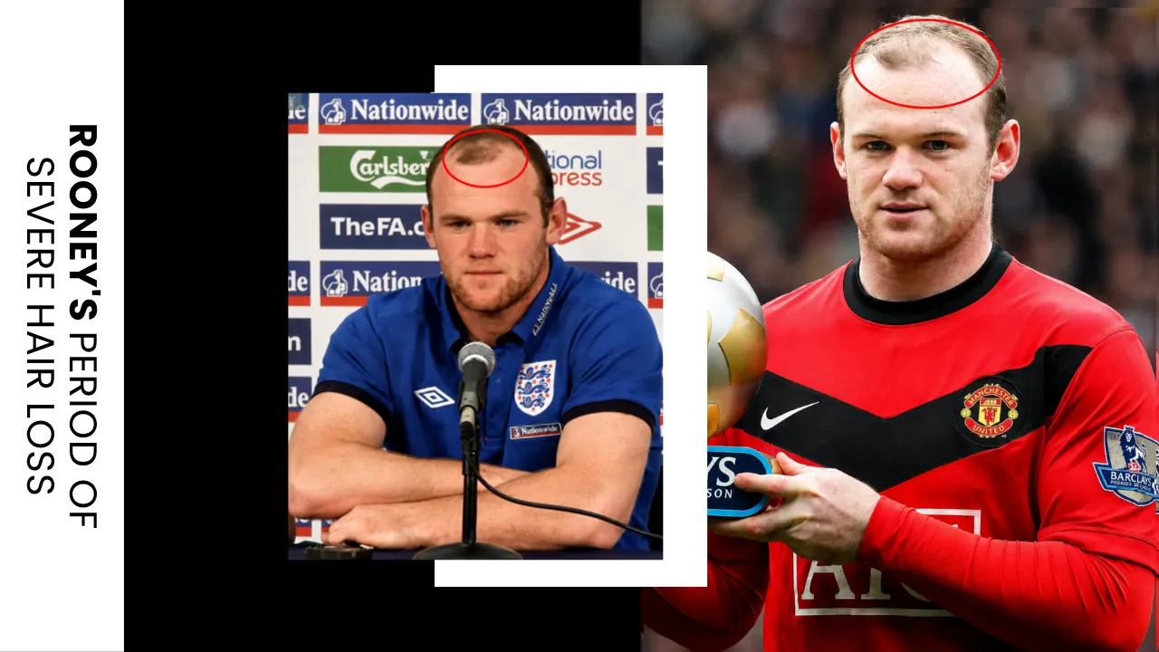Wayne Rooney severe hair loss period showing advanced frontal recession before his hair transplant procedure