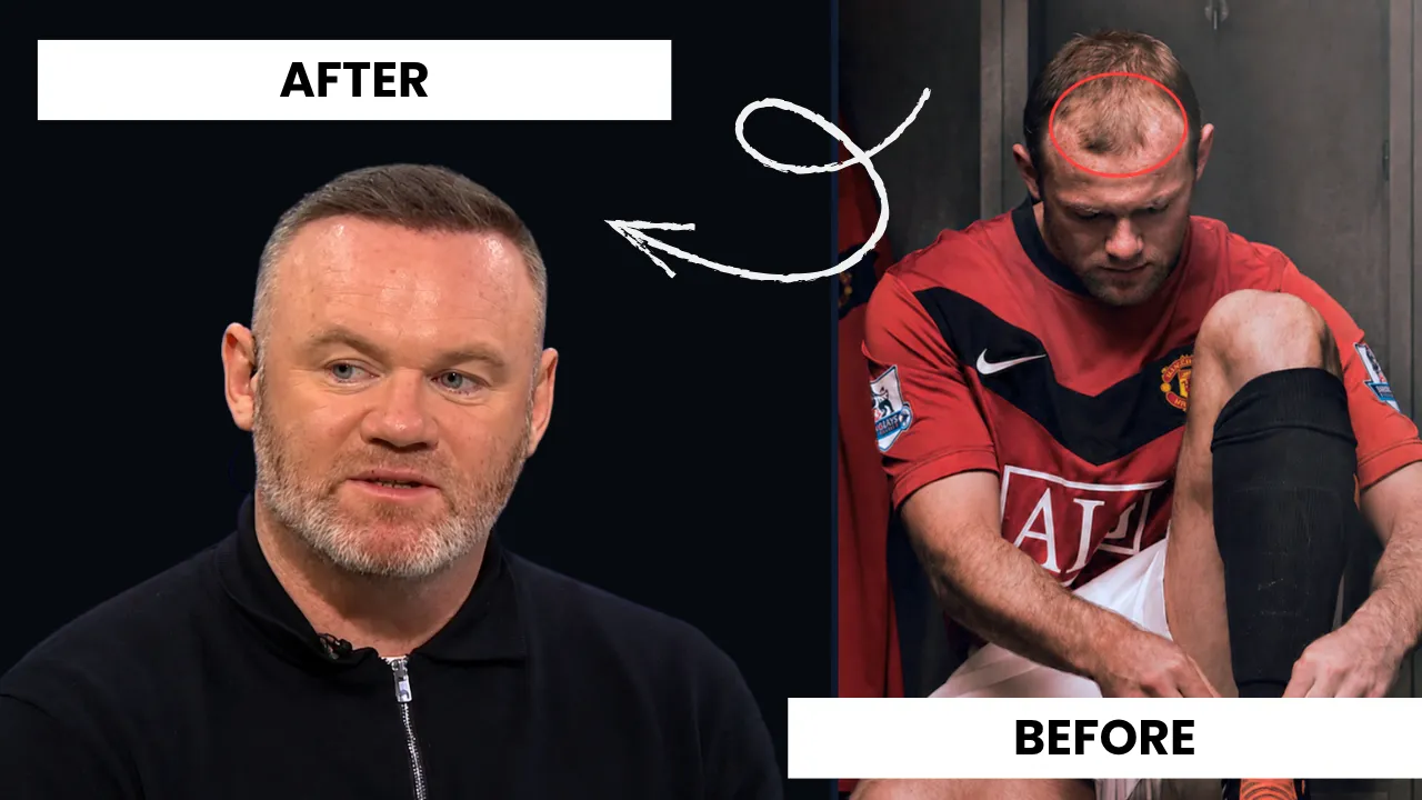 Wayne Rooney hair transplant before and after comparison showing restored hairline and improved density