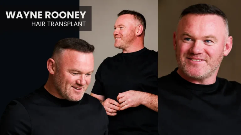 Wayne Rooney Hair Transplant Before And After Results, Hair Restoration Journey And Long-Term Transformation