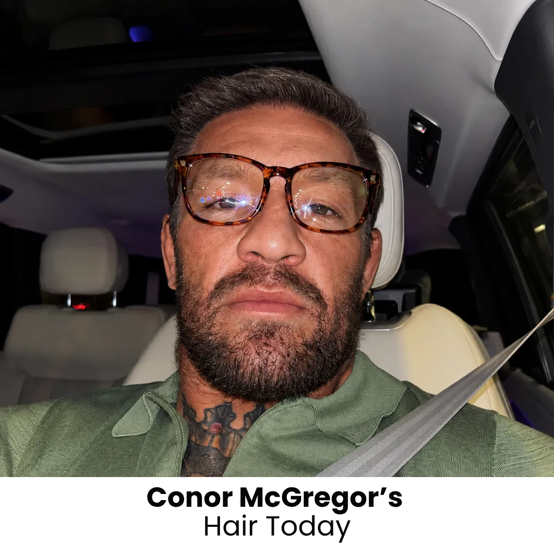 Conor McGregor Beard Transplant Conor McGregor beard transplant and facial hair density analysis