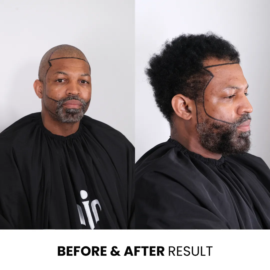 Afro Hair Transplant Cost In 2026: Real Prices, Graft Numbers & Results 11 Afro Hair Transplant Before And After Result Showing Hairline Restoration And Treatment Planning