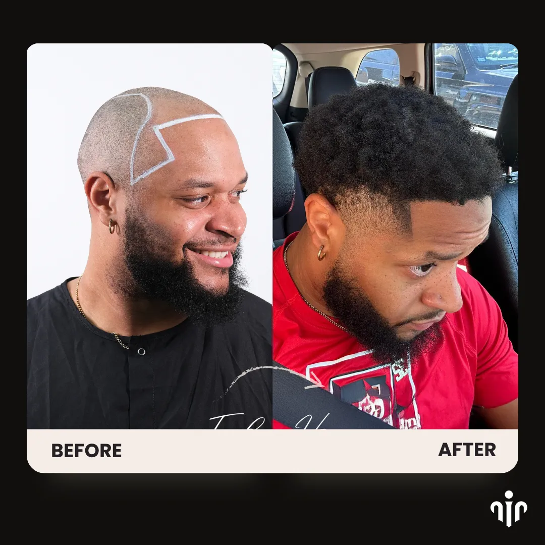 Afro hair transplant before and after result showing restored frontal hairline, temple coverage, and natural curly hair density