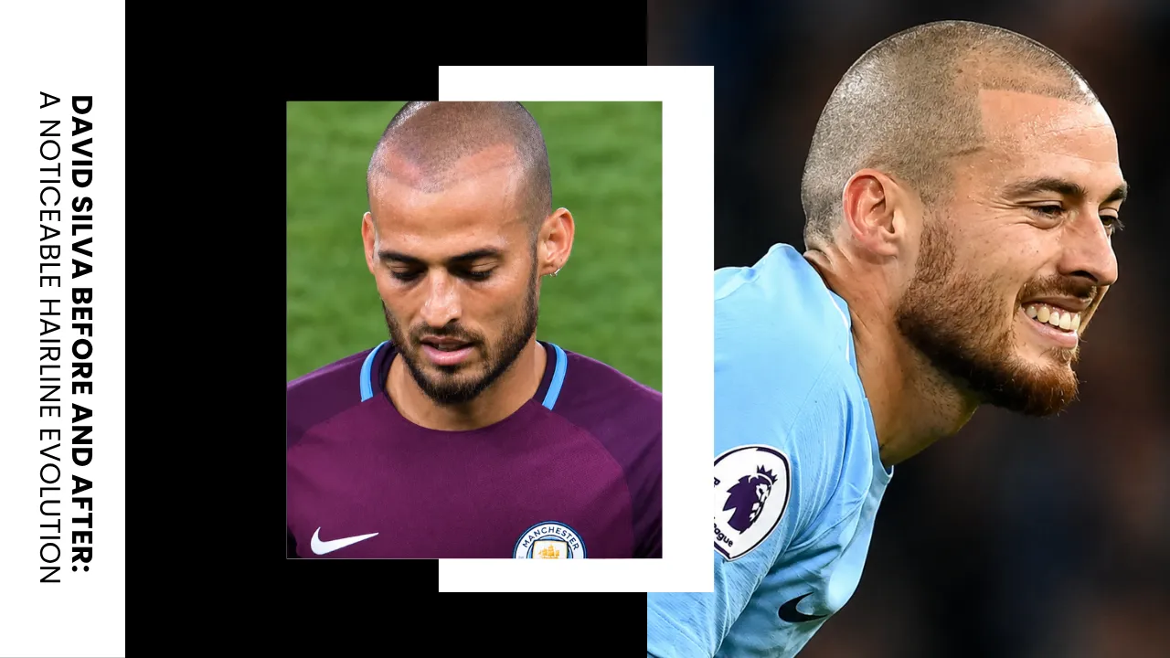 david-silva-hair-transplant-before-after-comparison.webp David Silva hair transplant before and after comparison showing improved hairline density and temple restoration
