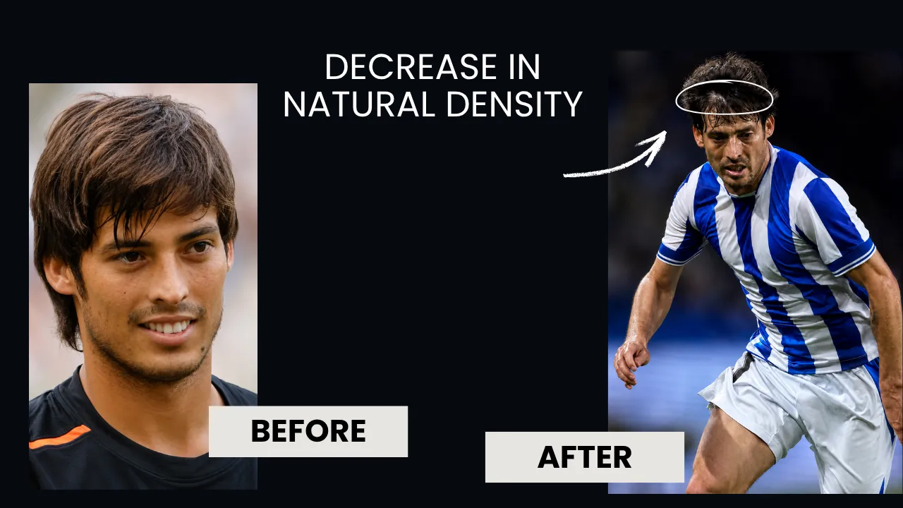 david-silva-hair-transplant-early-career-hairline.webp David Silva hair loss progression showing reduced natural hair density and early signs of hairline recession