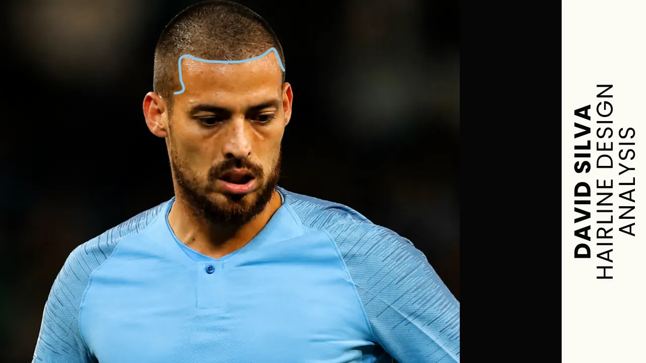 david-silva-hairline-restoration-result.webp David Silva hairline design analysis showing frontal hairline shape and temple restoration pattern