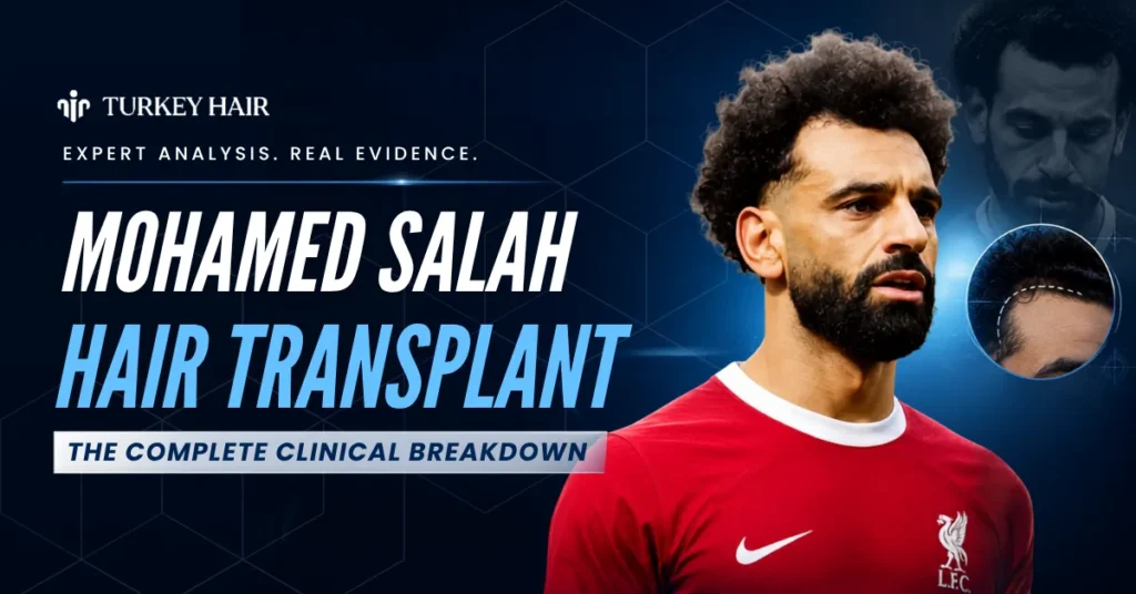 Mohamed Salah Hair Transplant, Did Mohamed Salah Get A Hair Transplant, Mohamed Salah Hairline, Mohamed Salah Before After, Celebrity Hair Transplant, Footballer Hair Transplant, Mohamed Salah Hair Restoration, Turkey Hair Center Analysis