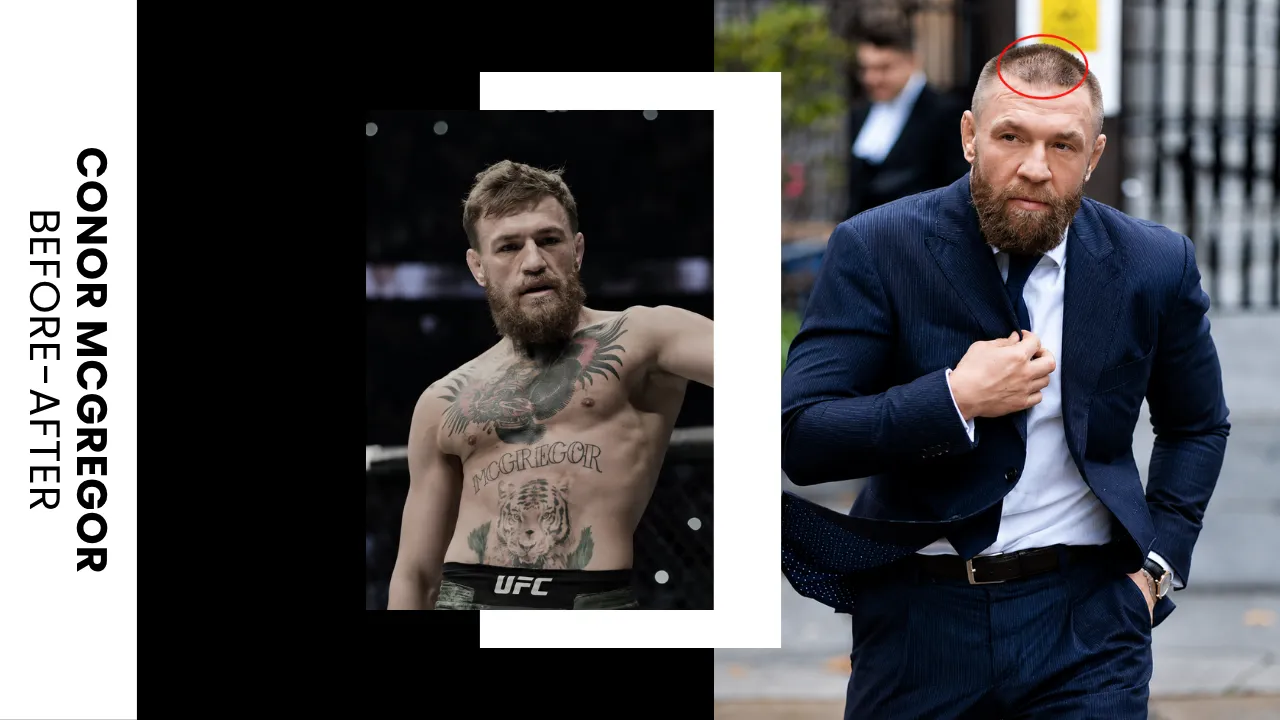 Conor McGregor Hair Transplant Scar Analysis Conor McGregor hair transplant scar visibility and hairline restoration analysis
