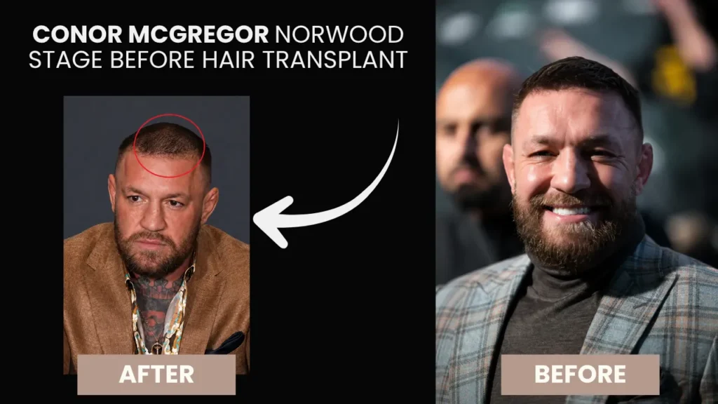 Conor McGregor Before and After Hair Transplant Conor McGregor before and after hair transplant Norwood stage hairline comparison