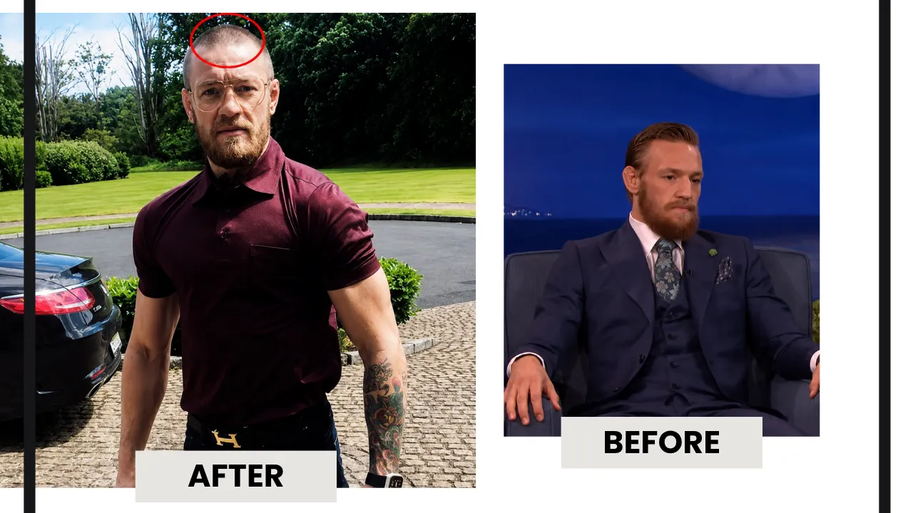 Conor McGregor Hair Transplant Before and After Comparison Conor McGregor hair transplant before and after hairline density comparison