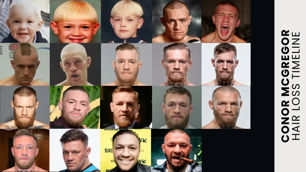 Conor McGregor Hair Loss Timeline Conor McGregor hair loss timeline and hair transplant transformation over the years