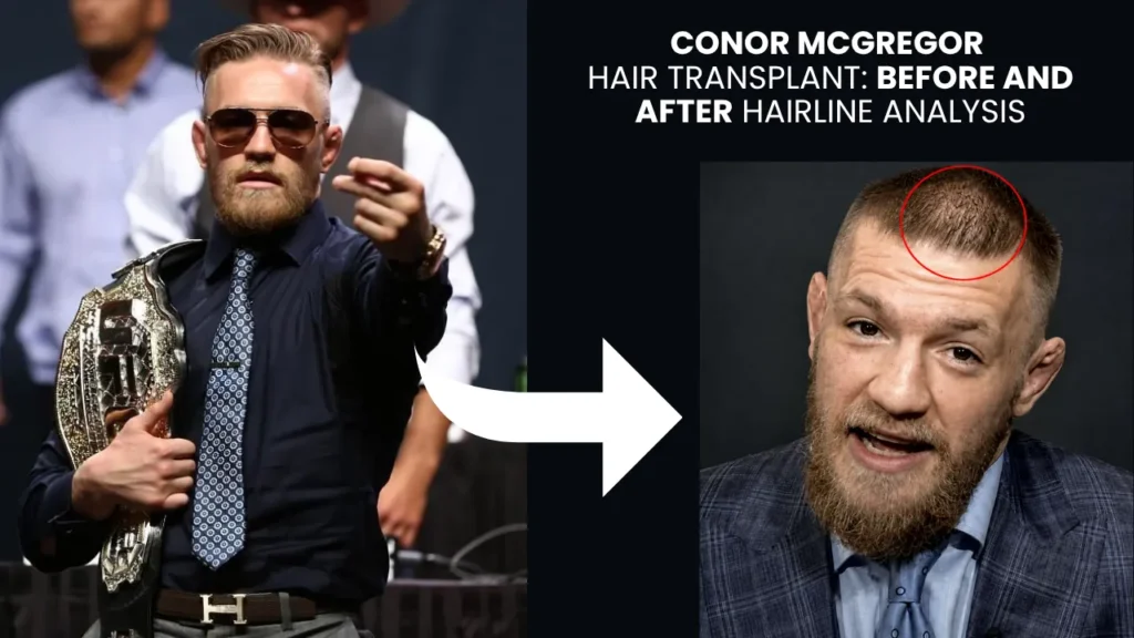 Conor McGregor hair transplant before and after hairline restoration analysis