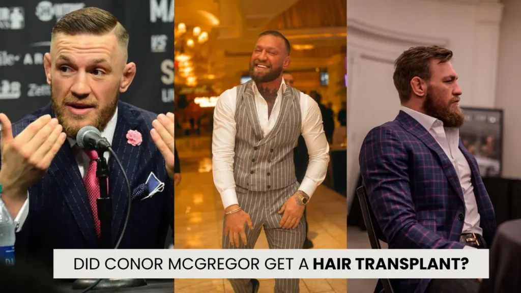 Did Conor McGregor get a hair transplant hairline and density transformation analysis
