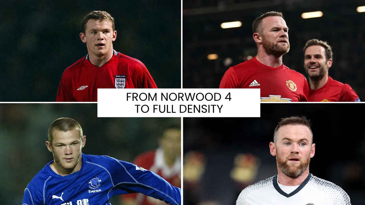 Wayne Rooney hair transplant transformation from advanced hair loss to improved density and restored hairline