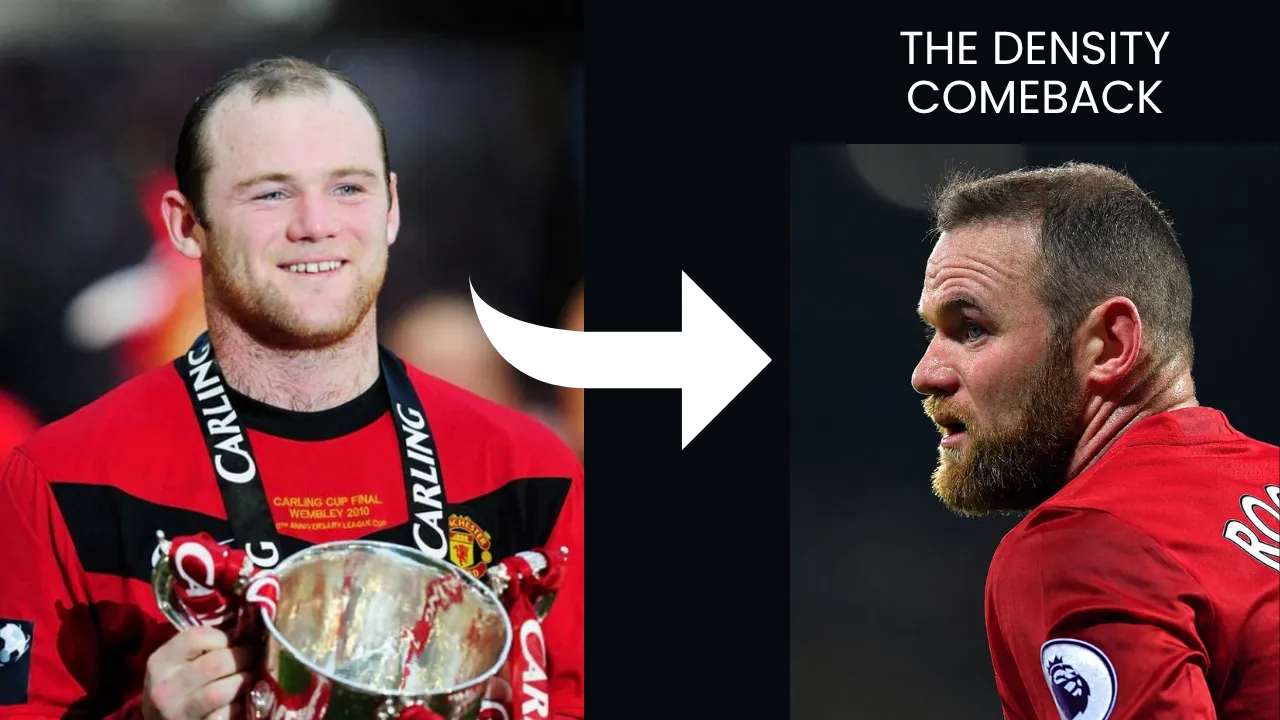 Wayne Rooney hair transplant before and after comparison showing improved hair density and restored hairline