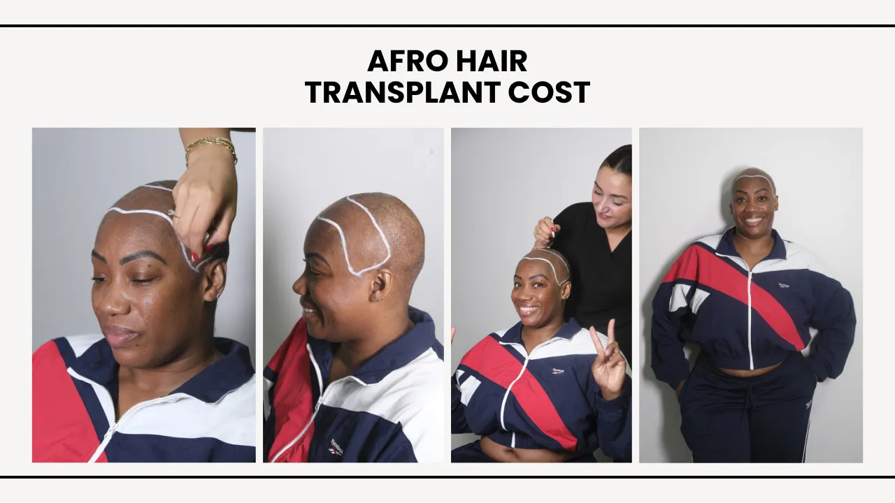 Afro Hair Transplant Cost In 2026: Real Prices, Graft Numbers & Results 10 Afro Hair Transplant Cost In Turkey With Female Patient Consultation And Hairline Design