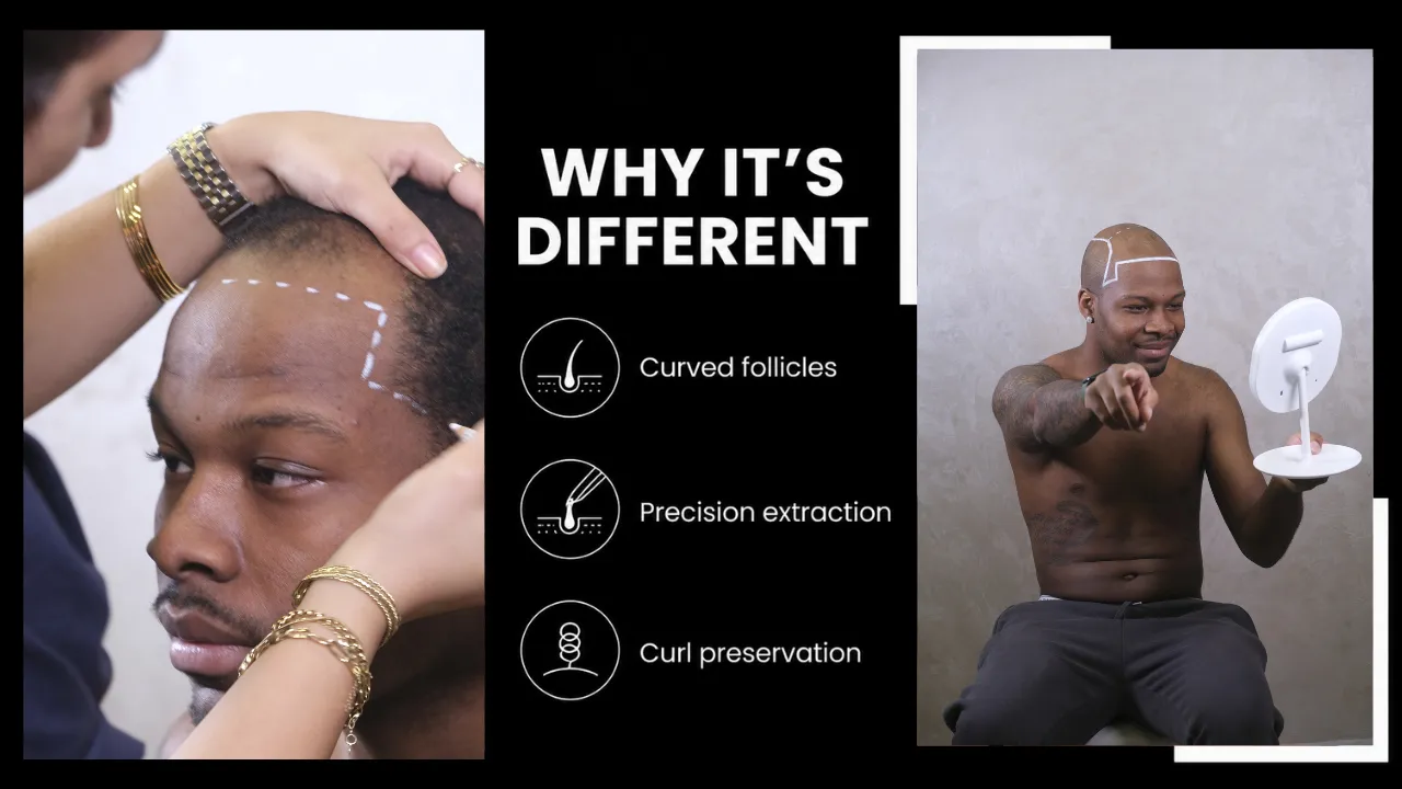 Afro Hair Transplant Cost In 2026: Real Prices, Graft Numbers & Results 12 Afro Hair Transplant Procedure Showing Hairline Design And Curl-Preserving Technique