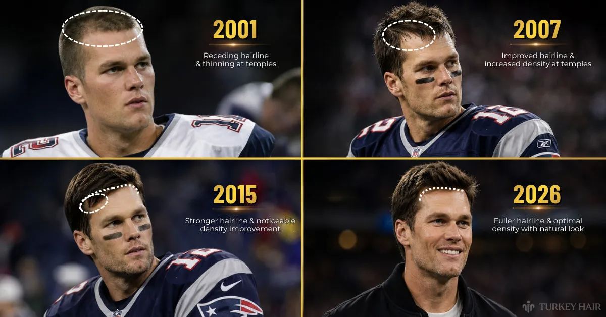 om brady hair transplant timeline, tom brady hair 2001 vs 2026, did tom brady lose his hair, tom brady hairline over the years, tom brady hair transformation