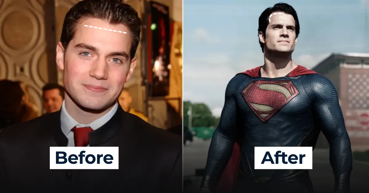 Henry Cavill hair, Hair transplant rumors, Celebrity hairline, Male pattern baldness, Hair restoration, FUE DHI
