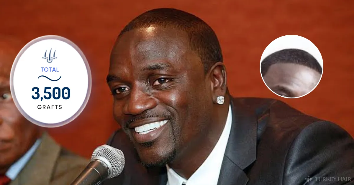 Akon 3500 grafts, Akon graft estimate, Akon hair transplant analysis, Akon hairline restoration, Akon scalp analysis, celebrity graft count, hair transplant graft planning