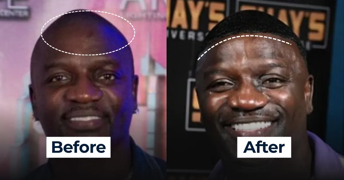 Akon hairline evolution, Akon hair transplant 2025, Akon before after hairline, Akon hair loss transformation, celebrity hairline change, Akon hair restoration results, hairline analysis