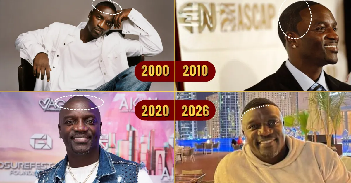 Akon hair loss timeline, Akon hairline over the years, Akon hair transplant rumors, Akon bald look, Akon hair transformation, celebrity hair loss timeline, Akon 2000 2026 hair