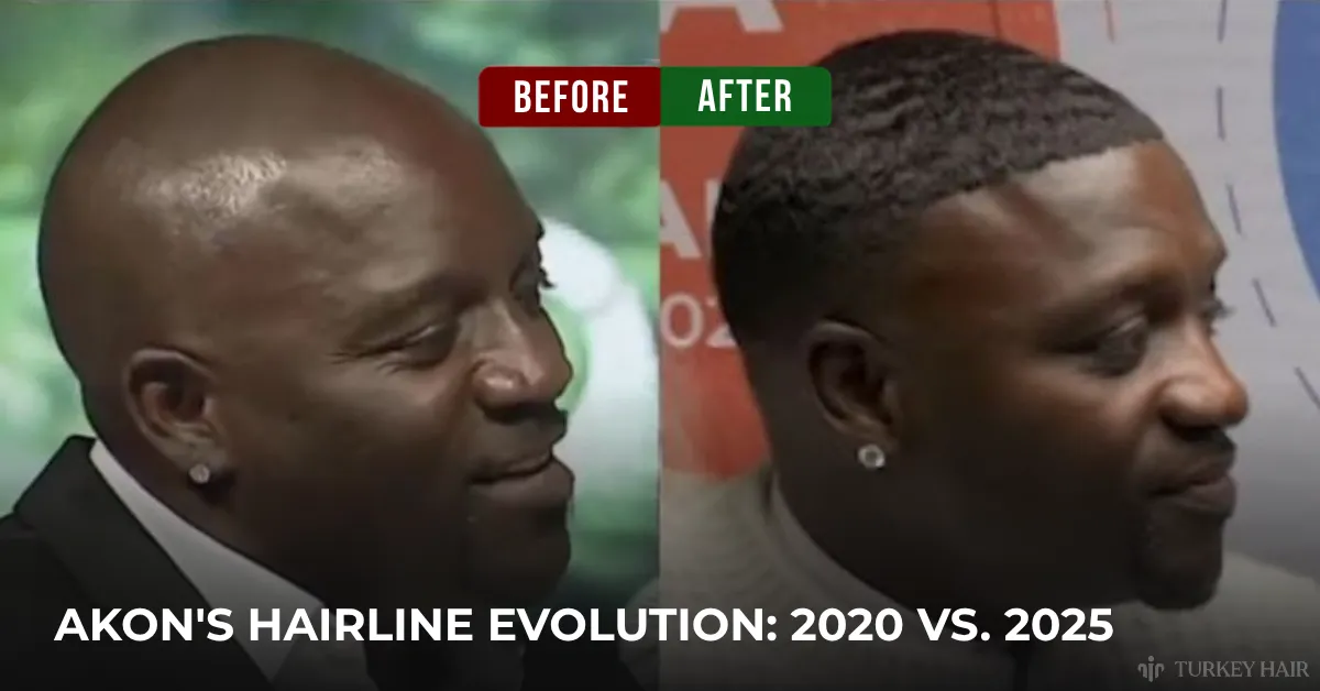 Akon before after hair transplant, Akon hairline transformation, Akon hair restoration result, Akon hair density improvement, celebrity hair transplant before after, Akon hairline change, natural hair transplant result