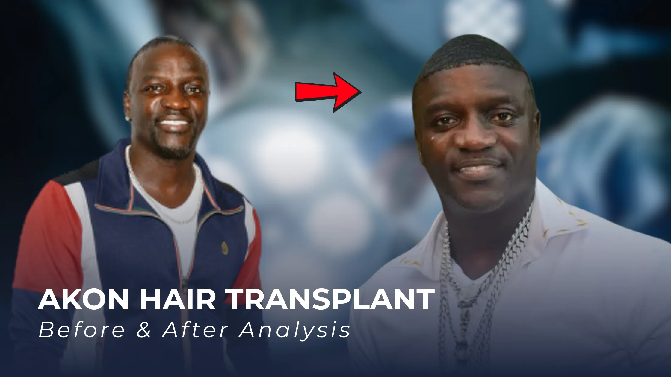 Akon hair transplant, Akon before after, Akon hairline analysis, Akon hair transplant Turkey, celebrity hair restoration, hairline transformation