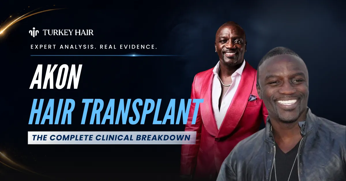 Akon Hair Transplant: Cost, Turkey Procedure, Hairline Results and What We Can Learn