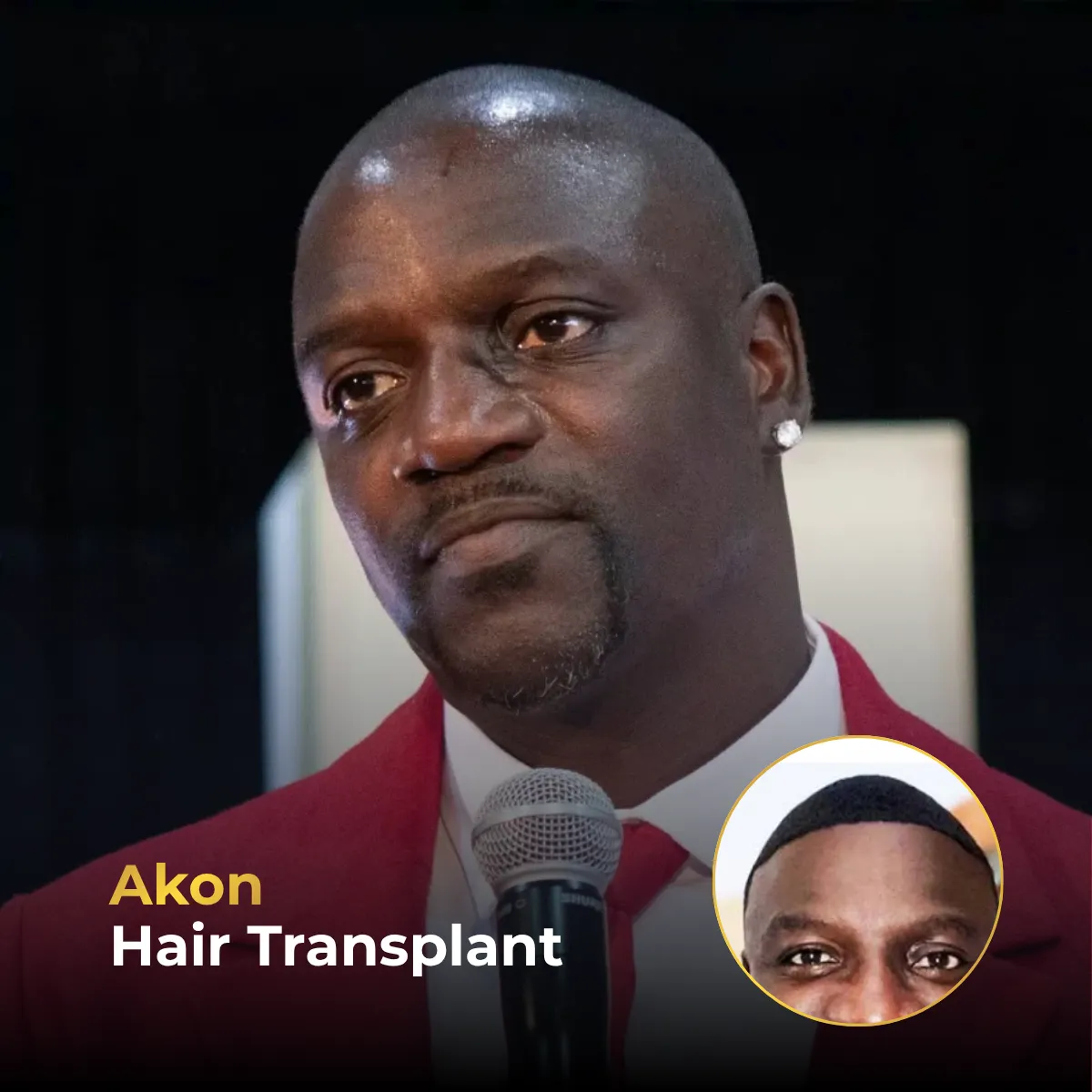 Akon hairline analysis, Akon hair transplant, Akon hair restoration, Akon graft estimate, celebrity hair transplant Turkey, hairline transformation