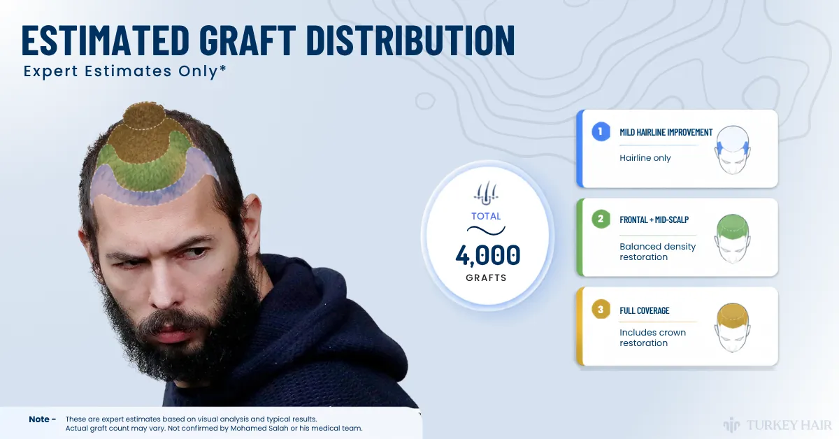 Diagram illustrating estimated graft distribution for a hair transplant on a scalp similar to Andrew Tate's, showing areas for frontal and mid-scalp density.