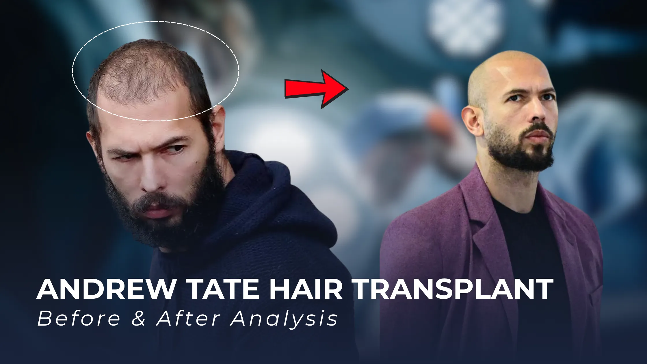 Andrew Tate hair transplant, Andrew Tate hairline analysis, Andrew Tate before after, celebrity hair transplant, 4000 grafts analysis, hair restoration rumors